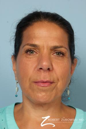 Chin Augmentation: Patient 4 - After Image 1