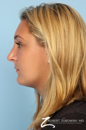 Rhinoplasty: Patient 18 - After Image 2