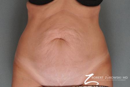 Tummy Tuck: Patient 10 - Before Image 1