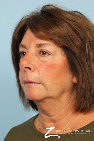 Blepharoplasty: Patient 37 - After Image 2
