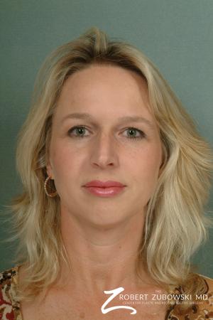 Chin Augmentation: Patient 3 - Before Image 1