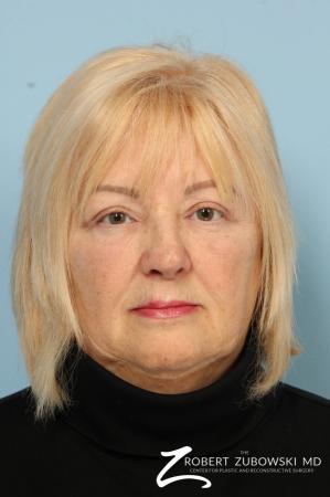 Blepharoplasty: Patient 16 - After Image 1