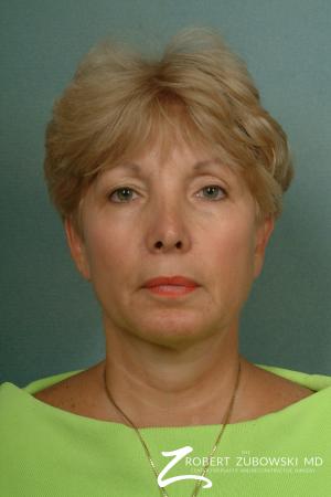 Neck Lift: Patient 2 - After Image 1