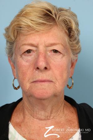 Blepharoplasty: Patient 30 - Before Image 1