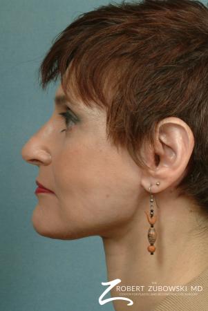 Facelift: Patient 9 - After Image 2