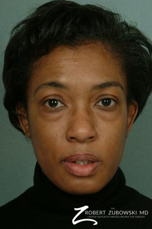 Blepharoplasty: Patient 3 - Before Image 1