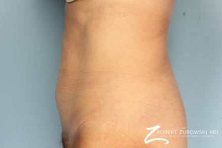 CoolSculpting®: Patient 4 - Before Image 2
