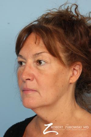 Chemical Peel: Patient 1 - Before and After Image 2