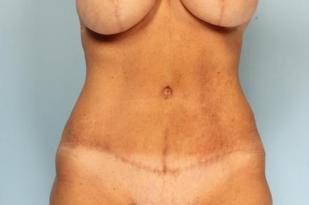 Tummy Tuck: Patient 23 - After Image 1