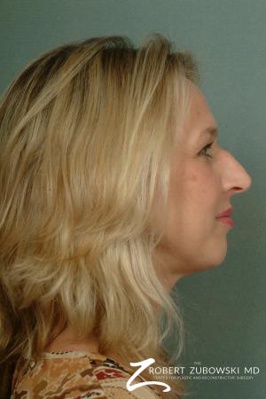 Rhinoplasty: Patient 10 - Before and After Image 3