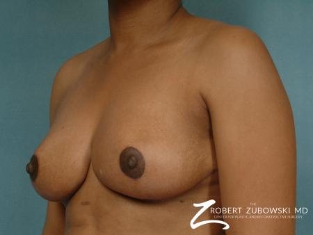 Breast Reduction: Patient 2 - After Image 2