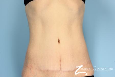 Tummy Tuck: Patient 12 - After Image 1