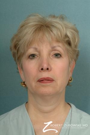 Neck Lift: Patient 2 - Before Image 1