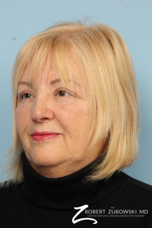 Blepharoplasty: Patient 16 - After Image 2