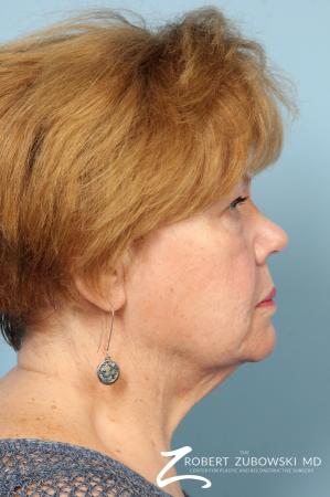 Facelift: Patient 26 - Before and After Image 2
