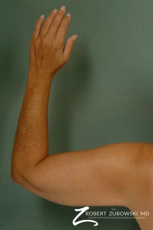 Liposuction: Patient 23 - After Image 1