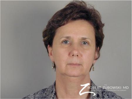 Brow Lift: Patient 2 - Before Image 1