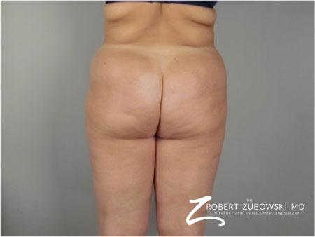 Liposuction: Patient 41 - Before and After Image 3