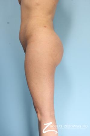 Butt Augmentation: Patient 2 - After Image 1