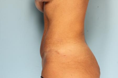 Tummy Tuck: Patient 23 - After Image 3