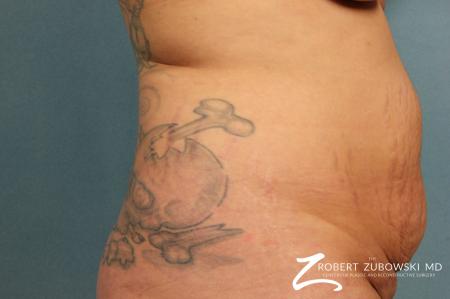 Tummy Tuck: Patient 3 - Before and After Image 2