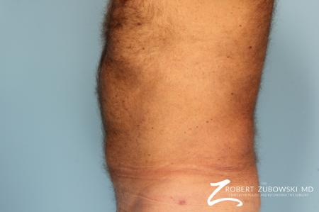Liposuction: Patient 18 - After Image 2