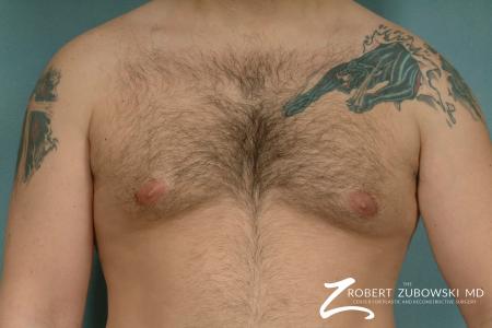 Gynecomastia: Patient 9 - After Image 1