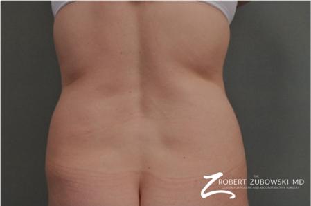Liposuction: Patient 36 - Before Image 1