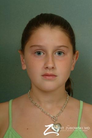 Otoplasty: Patient 3 - After Image 1