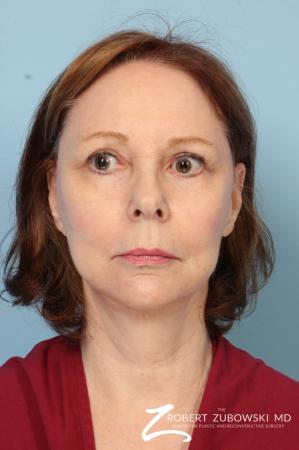 Facelift: Patient 17 - Before Image 1