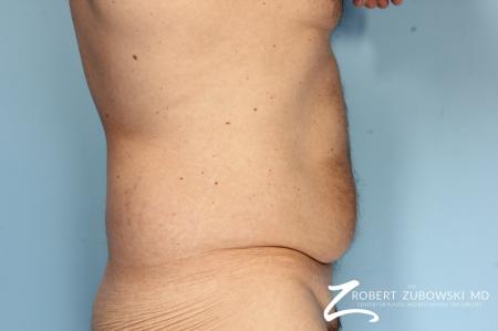 Body Lift: Patient 8 - Before and After Image 3
