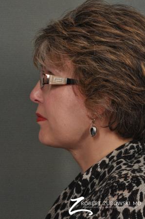 Neck Lift: Patient 7 - After Image 2