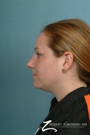 Rhinoplasty: Patient 5 - Before and After Image 2