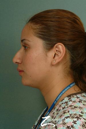 Rhinoplasty: Patient 13 - Before and After Image 2