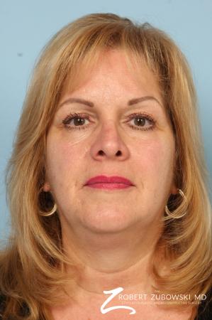 Blepharoplasty: Patient 34 - Before Image 1