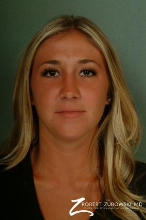 Rhinoplasty: Patient 1 - After Image 1