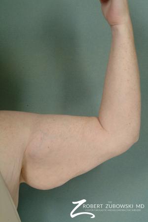 Arm Lift: Patient 3 - Before Image 1