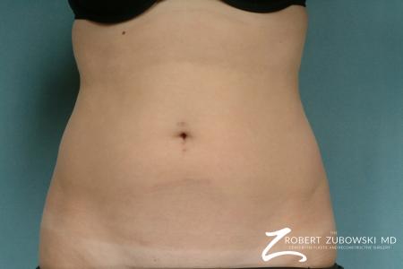 Liposuction: Patient 31 - Before Image 1