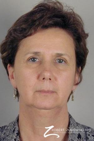 Facelift: Patient 8 - Before Image 1