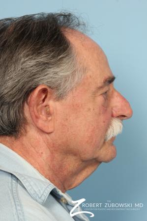 Neck Lift: Patient 6 - Before and After Image 2