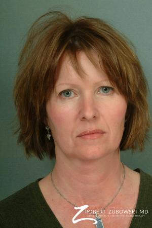 Facelift: Patient 5 - Before Image 1