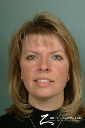 Blepharoplasty: Patient 7 - After Image 1