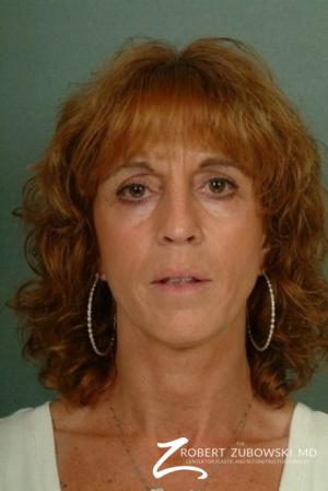 Blepharoplasty: Patient 8 - After Image 1