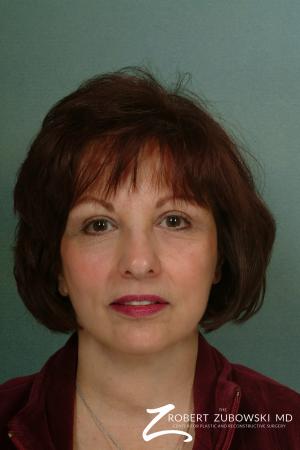 Facelift: Patient 2 - After Image 1