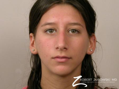 Rhinoplasty: Patient 8 - Before Image 1