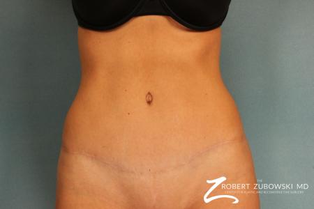 Tummy Tuck: Patient 10 - After Image 1