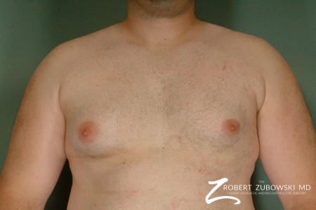 Gynecomastia: Patient 7 - Before Image 1