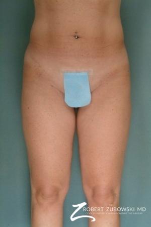 Liposuction: Patient 4 - After Image 1