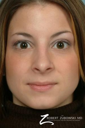 Rhinoplasty: Patient 6 - After Image 1