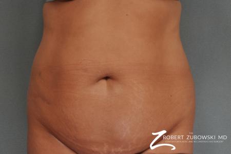 Tummy Tuck: Patient 21 - Before Image 1